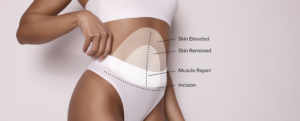 Abdominal cosmetic surgery diagram with labeled layers: skin removed, skin elevated, muscle repair, and incision.