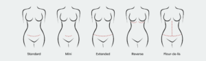 Five silhouettes show tummy tuck scar patterns labeled Standard, Mini, Extended, Reverse, Flour-de-lis.
