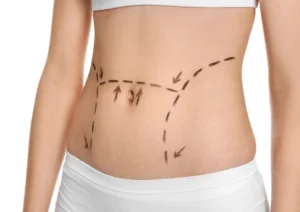 Why Skin Elasticity Matters in Liposuction