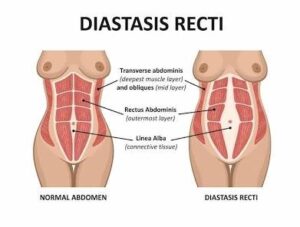 Diagram comparing normal abdomen and diastasis recti in women, with labeled abdominal muscle layers and separated rectus muscles on the right